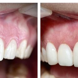 Soda City Smiles - Patient 2 before and after