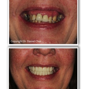 North Texas Dental Surgery - All on 4 Dental Implants - before and after - Oral Surgeons Near Me - McKinney, Texas
