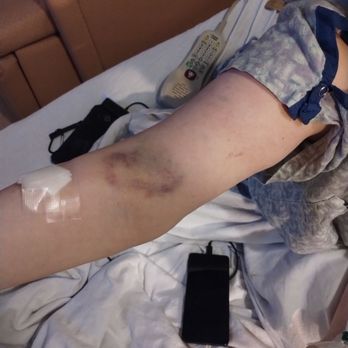 Saint Francis Hospital - This bruise eventually covered my ENTIRE arm. - Hospitals Near Me - Memphis, Tennessee Saint Francis Hospital - This bruise eventually covered my ENTIRE arm. - Hospitals Near Me - Memphis, Tennessee