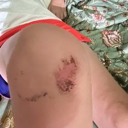 Doris Dickson Elementary School - Scarped knee from a kid pushing him down at school.