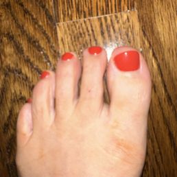 Crooked toe nail cut. Crooked toe nail cut.
