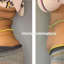 Body Sculpting by Za - Lipo laser results