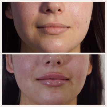 Ageless MD - Dr. Tsay did an amazing job and gave me a very natural pout! - Medical Spas Near Me - Tustin, California Ageless MD - Dr. Tsay did an amazing job and gave me a very natural pout! - Medical Spas Near Me - Tustin, California
