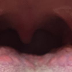 Exer Urgent Care - West Hills - Welts on back of her tongue