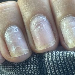 V Nails - Divots in my nails!!!