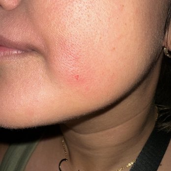 European Wax Center - I had an upper lip and brow wax. I didn't expect to leave with a piece of my face missing - Waxing Near Me - Davis, California European Wax Center - I had an upper lip and brow wax. I didn't expect to leave with a piece of my face missing - Waxing Near Me - Davis, California