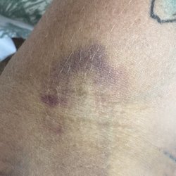 Quest Diagnostics - A huge bruise