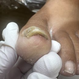 Before photo showing symptoms of nail psoriasis. Before photo showing symptoms of nail psoriasis.