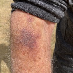 Clinical Pathology Laboratories - Bruise 4 days after simple blood draw. Can tell its not even near the crease where the blood vessel is!