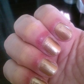 Love Nails - Infection I recieved from Love Nails in Chino, CA. (01.28.16) - Nail Technicians Near Me - Chino, California Love Nails - Infection I recieved from Love Nails in Chino, CA. (01.28.16) - Nail Technicians Near Me - Chino, California