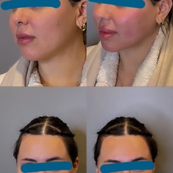 Re-Nu Aesthetics - chin by Gina