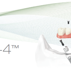 Bryant Dental - If you wear dentures or have a mouthful of missing or failing teeth, the All-on-4 procedure is the optimal solution.