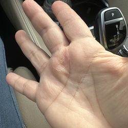 Cypress Orthopedics - My 1mo POST OP of my Trigger Release Surgery with Dr Bell. Finger still but swollen and I'm maybe 80% better. No pain at least.