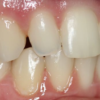 Christopher M Herman, DDS - Actual Patient Before Bonding Procedure - Cosmetic Dentists Near Me - Oceanside, California Christopher M Herman, DDS - Actual Patient Before Bonding Procedure - Cosmetic Dentists Near Me - Oceanside, California