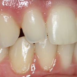 Christopher M Herman, DDS - Actual Patient Before Bonding Procedure