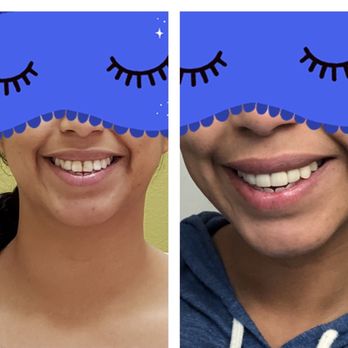 Dentistry by Dr. Doshi - *vulnerable post* before & after. I'm feeling so confident with my new smile! - Cosmetic Dentists Near Me - Diamond Bar, California Dentistry by Dr. Doshi - *vulnerable post* before & after. I'm feeling so confident with my new smile! - Cosmetic Dentists Near Me - Diamond Bar, California