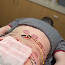 Rivernorth Acupuncture - Acupuncture treatment with electric stimulation for lower back pain and sciatica after cupping therapy