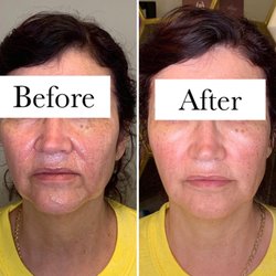 Regenerative Wellness Center - Lip Fillers W/ PRP under eyes and cheeks