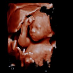 Stork Vision Madison - 27weeks