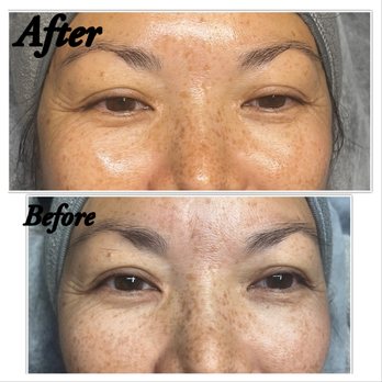 Soom Esthetics - Facial before and after - Eyelash Service Near Me - Los Angeles, California Soom Esthetics - Facial before and after - Eyelash Service Near Me - Los Angeles, California