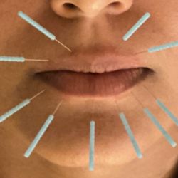 Juvemed wellness - Lip rejuvenation/ Lip plump