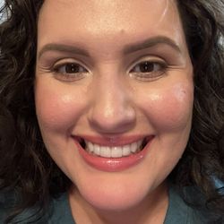 South Flores Family Dental - Veneers on four front teeth