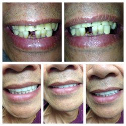 Callas Yvonne DMD - Dentures for a smile this patient was proud to show off!