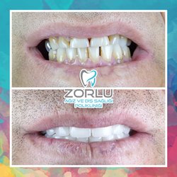 Zorlu Ağız ve Diş Sağlığı Polikliniği - Estetik Gülüş Tasarımı
