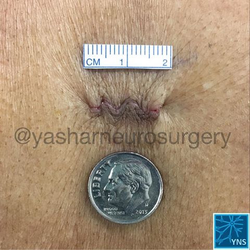 Parham Yashar MD, FACS - Yashar Neurosurgery - Minimally-Invasive Spine Surgery (MIS): Size does matter. Ask Dr. Yashar if MIS is an option for you!