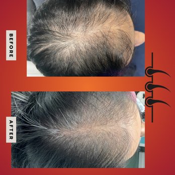 Aesthetics Care Med Spa - Prp hair restoration - Medical Spas Near Me - Coconut Creek, Florida Aesthetics Care Med Spa - Prp hair restoration - Medical Spas Near Me - Coconut Creek, Florida