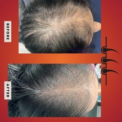 Aesthetics Care Med Spa - Prp hair restoration