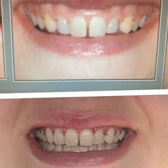 Smile By Design Dental Group - Phase 1: Top is my smile before any work. Bottom is phase 1, after gum trimming (before veneers). Who knew i could have big teeth?! - Cosmetic Dentists Near Me - Irvine, California Smile By Design Dental Group - Phase 1: Top is my smile before any work. Bottom is phase 1, after gum trimming (before veneers). Who knew i could have big teeth?! - Cosmetic Dentists Near Me - Irvine, California