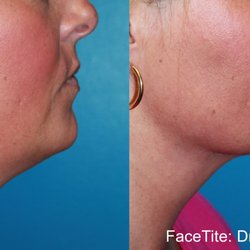 Aesthetics Med Spa - We are now offering FaceTite and Morpheus RF Microneedling for face and body.