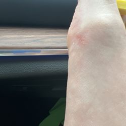 Comfort Nails - The skin rubbed off the side of my foot.