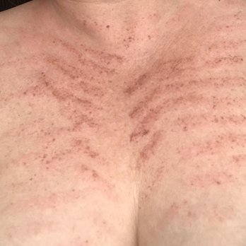BodyBrite - Austin - IPL burns - Laser Hair Removal Near Me - Austin, Texas
