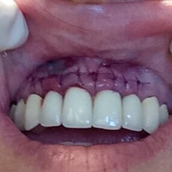 Bruce Holt, DDS - Had 3 Root Canals by Dr. Holt,  absolutely no pain!  I would highly recommend this Endodontist.