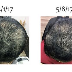 Damo Hair Loss Solution - Auto immune issue hair loss