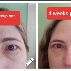 Robert E Feinfield, MD - Before & 4 weeks after surgery
