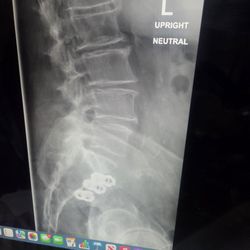 Greater Michigan Spine & Neurosurgery: Timothy Spencer, DO - SI JOINT PINS