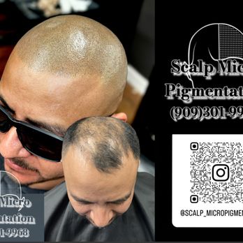 Scalp micropigmentation - Hair Loss Centers Near Me - Redlands, California