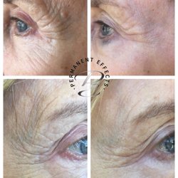 Permanent Effects - Plasma Pen Fibroblasting, two weeks after initial treatment. Results will continue to improve up to 12 weeks.