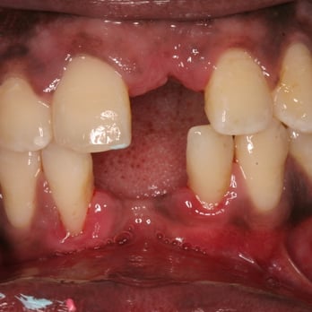 Benson Hill Smiles - Before: Missing teeth - General Dentistry Near Me - Renton, Washington Benson Hill Smiles - Before: Missing teeth - General Dentistry Near Me - Renton, Washington