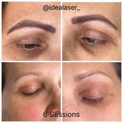 Idealaser Cosmetic Center of Miami - Mi tratamiento de remoción de microblading resultado después de 6 sesiones