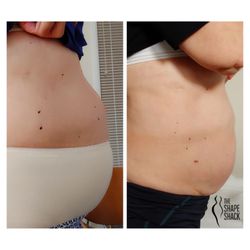 The Shape Shack - Reduction after 8 full sessions