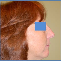 Navin Singh, MD - Rhinoplasty Before