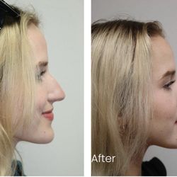 Rhinoplasty before and 6 weeks after