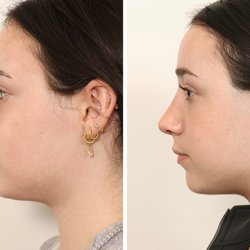 Benjamin Paul MD - Profile adjustment through rhinoplasty by Dr. Ben Paul