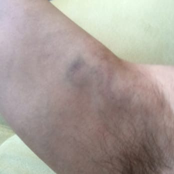Crews & Tangos - These two bruises were received because of the security guards/bouncers rough handling, inability to communicate, and lack of intelligence. - Gay Bars Near Me - Toronto, Ontario Crews & Tangos - These two bruises were received because of the security guards/bouncers rough handling, inability to communicate, and lack of intelligence. - Gay Bars Near Me - Toronto, Ontario