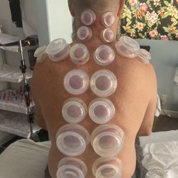 Phil De Ricco, LMT - Cupping