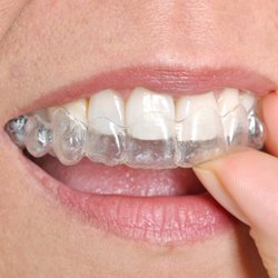 Mark J Gleckner, DMD - Invisalign